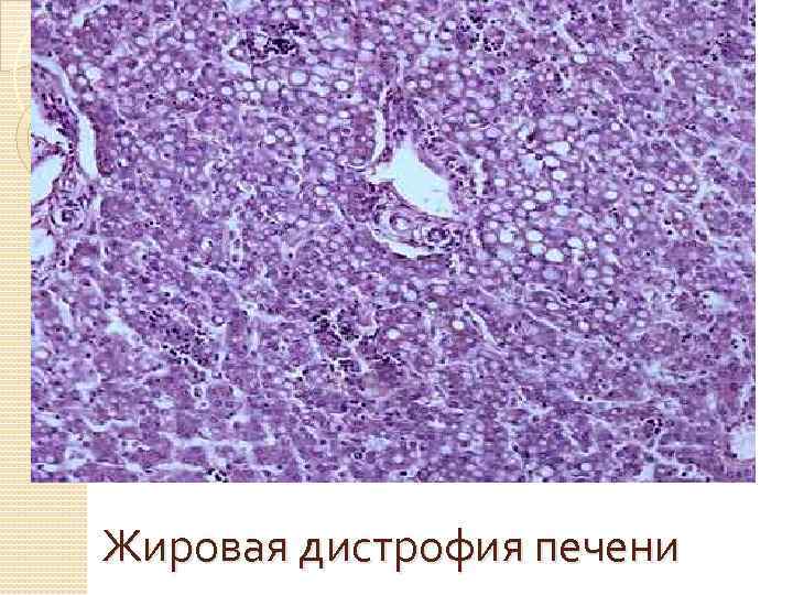 Жировая дистрофия печени 