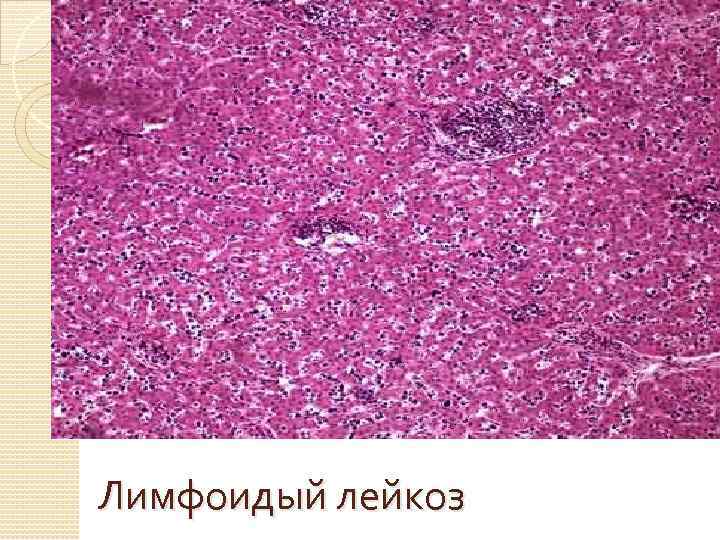 Лимфоидый лейкоз 