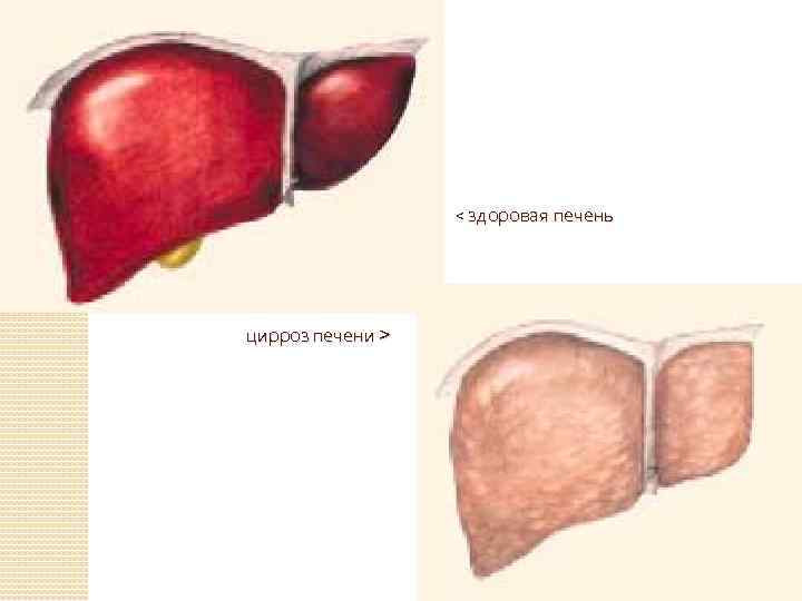< здоровая печень цирроз печени > 