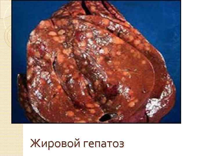 Жировой гепатоз 