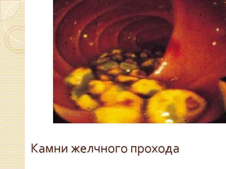 Камни желчного прохода 