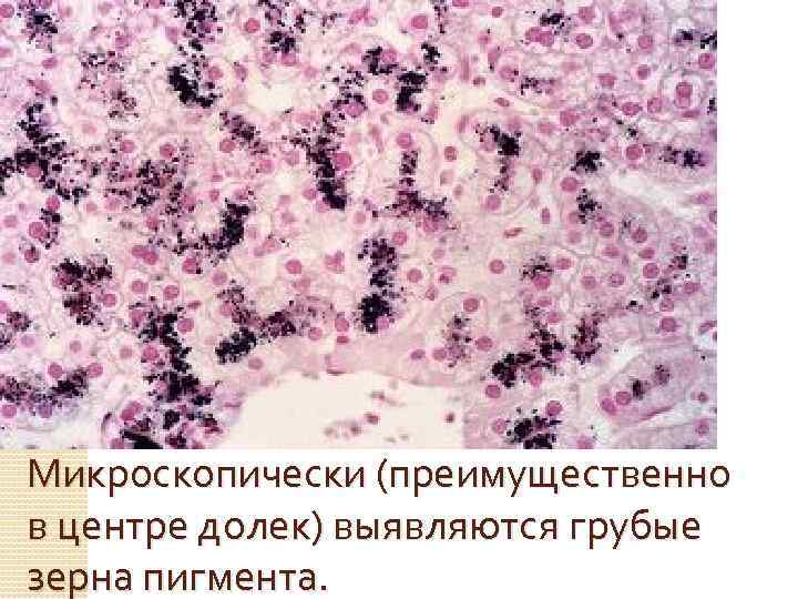 Дабина джонсона. Синдром Жильбера, Дабина-Джонсона. Шоколадная печень при синдроме Дабина-Джонсона. Синдром Дабина-Джонсона фото. Синдром Дабина-Джонсона и ротора.