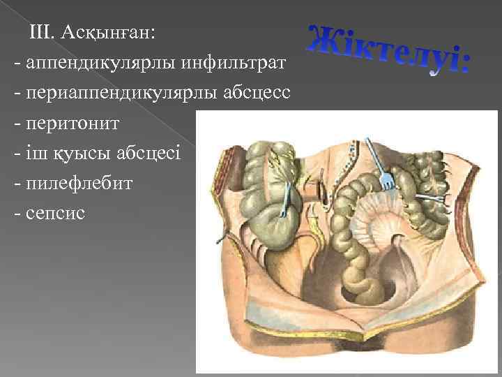 III. Асқынған: - аппендикулярлы инфильтрат - периаппендикулярлы абсцесс - перитонит - іш қуысы абсцесі