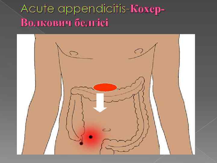 Acute appendicitis-Кохер. Волкович белгісі 