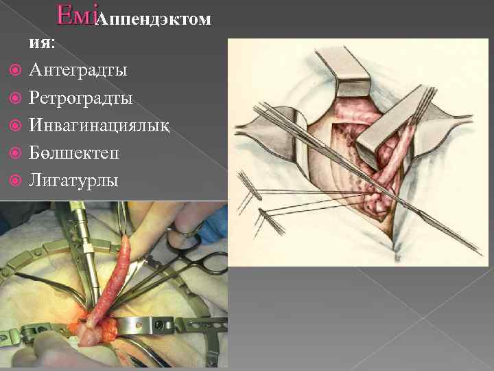 ЕміАппендэктом ия: Антеградты Ретроградты Инвагинациялық Бөлшектеп Лигатурлы 