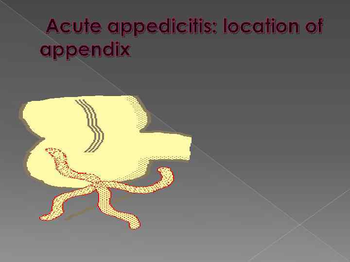 Acute appedicitis: location of appendix 