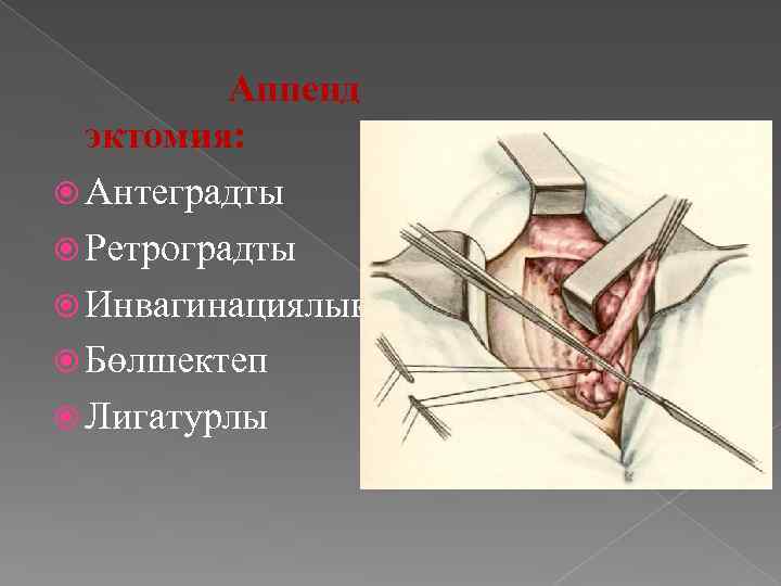 Аппенд эктомия: Антеградты Ретроградты Инвагинациялық Бөлшектеп Лигатурлы 