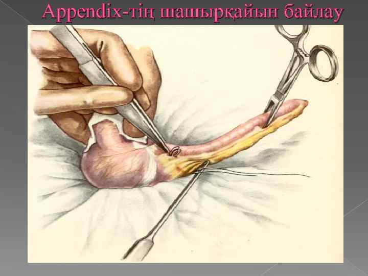 Appendix-тің шашырқайын байлау 
