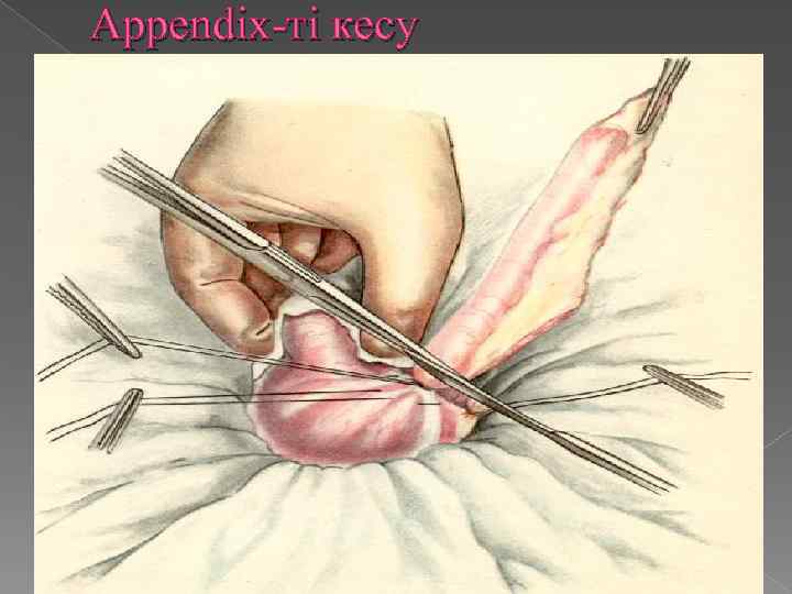 Appendix-ті кесу 