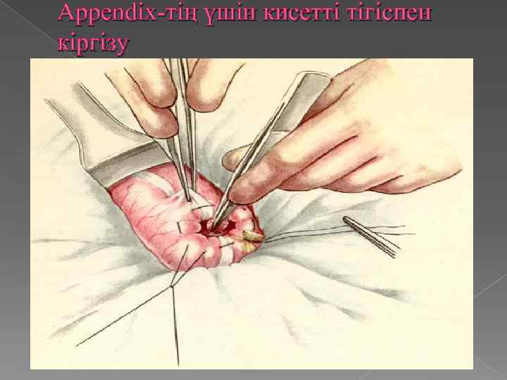 Appendix-тің үшін кисетті тігіспен кіргізу 