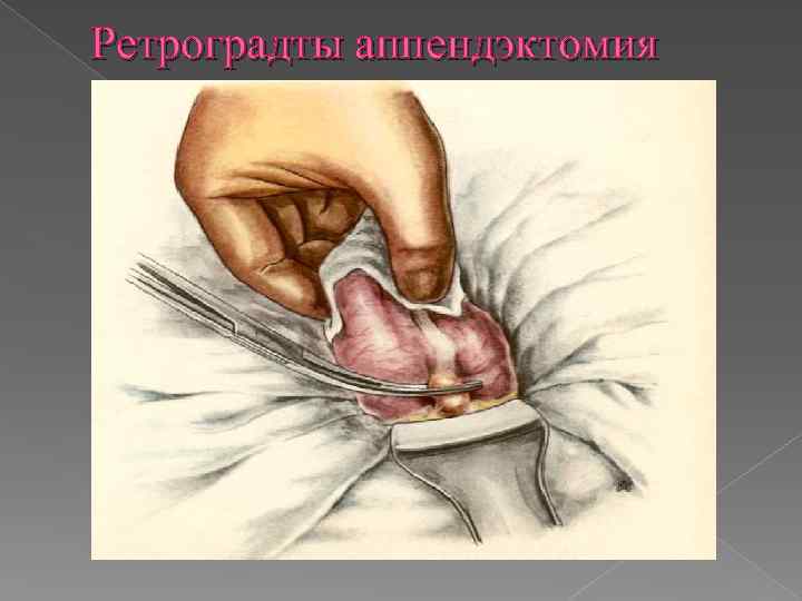 Ретроградты аппендэктомия 
