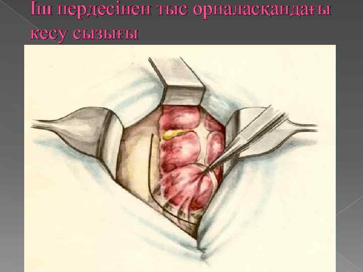 Іш пердесінен тыс орналасқандағы кесу сызығы 