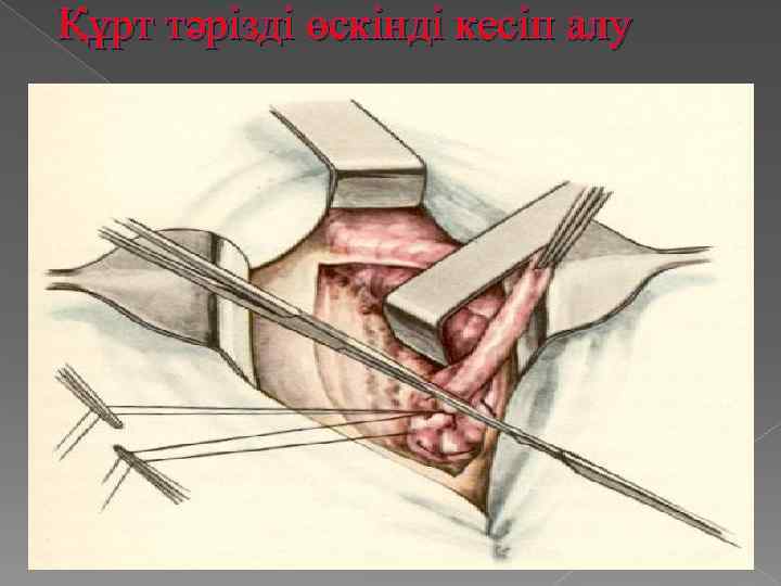 Құрт тәрізді өскінді кесіп алу 