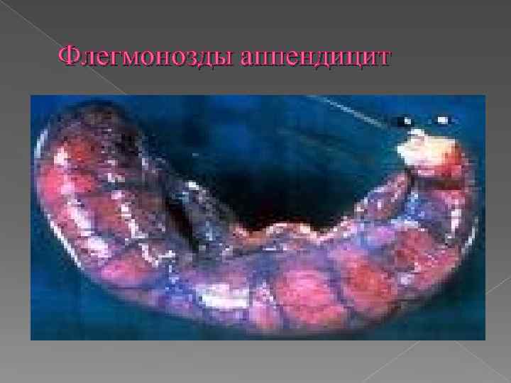 Флегмонозды аппендицит 