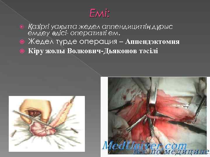 Емі: Қазіргі уақытта жедел аппендициттің дұрыс емдеу әдісі- оперативті ем. Жедел түрде операция –