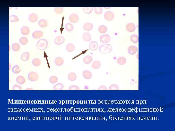 Мишеневидные эритроциты встречаются при талассемиях, гемоглобинопатиях, железодефицитной анемии, свинцовой интоксикации, болезнях печени. 