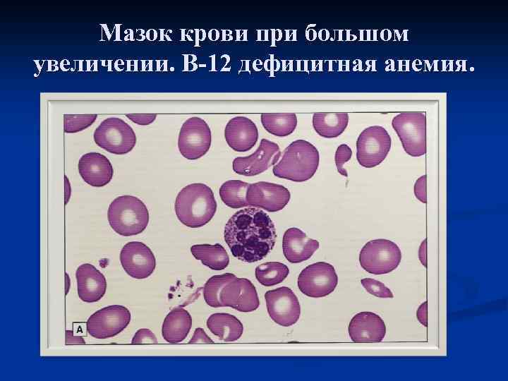 Мазок крови при большом увеличении. В-12 дефицитная анемия. 