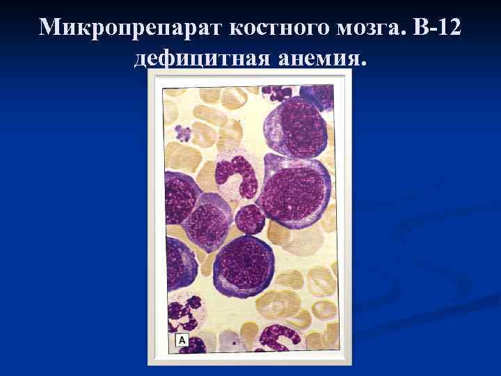 Микропрепарат костного мозга. В-12 дефицитная анемия. 