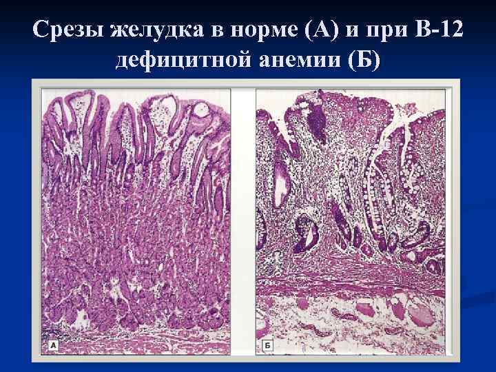 Срезы желудка в норме (А) и при В-12 дефицитной анемии (Б) 