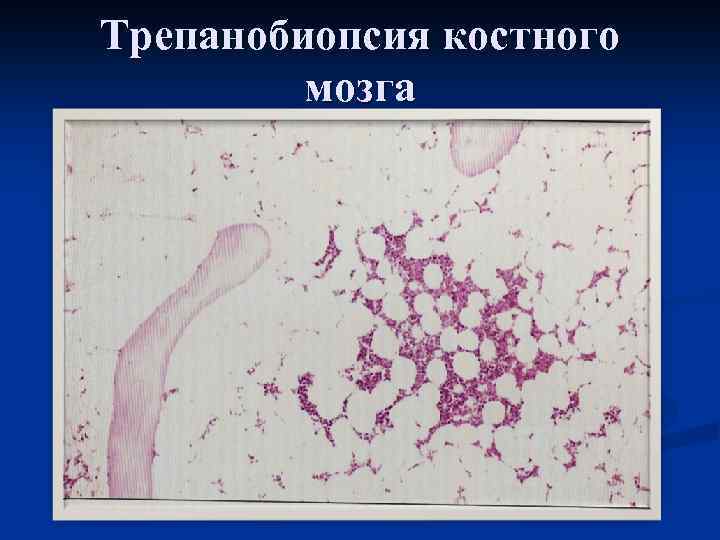 Трепанобиопсия костного мозга 