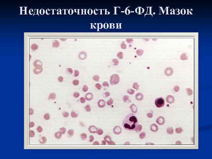 Недостаточность Г-6 -ФД. Мазок крови 