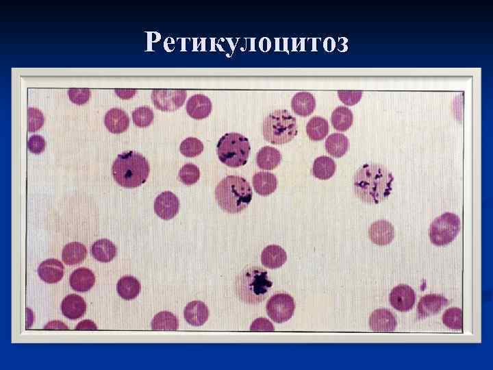 Повышенные ретикулоциты