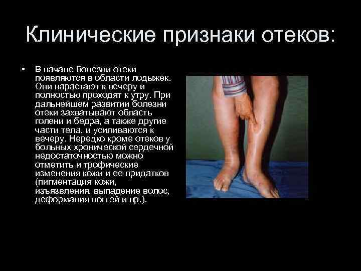 Клинические признаки отеков: • В начале болезни отеки появляются в области лодыжек. Они нарастают
