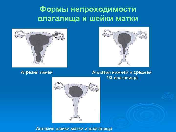 Формы непроходимости влагалища и шейки матки Атрезия гимен Аплазия нижней и средней 1/3 влагалища