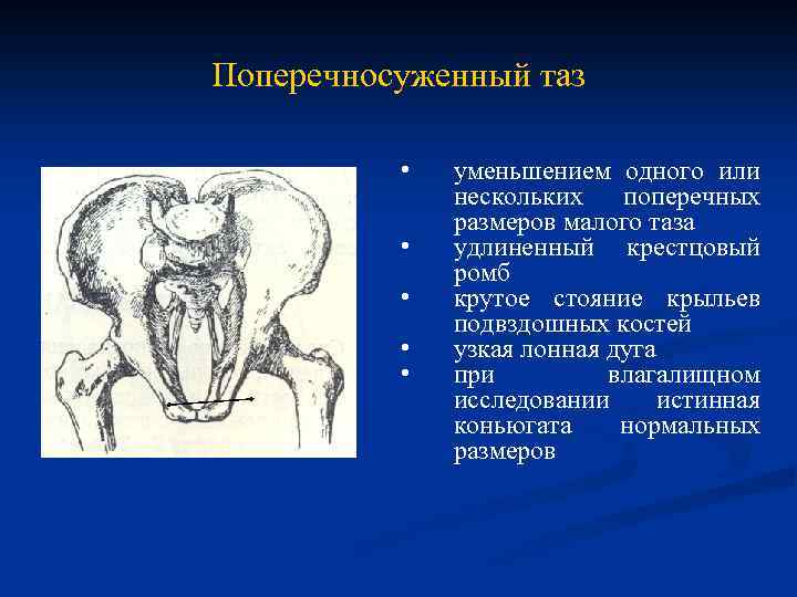 Поперечносуженный таз • • • уменьшением одного или нескольких поперечных размеров малого таза удлиненный