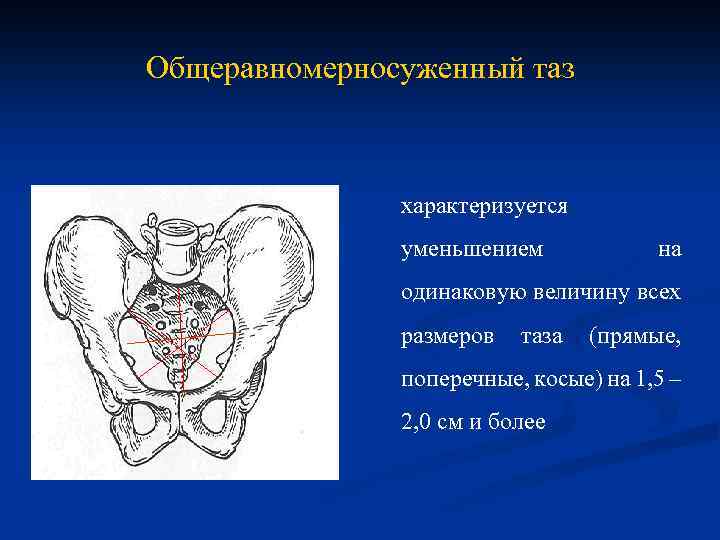 Узкий таз фото