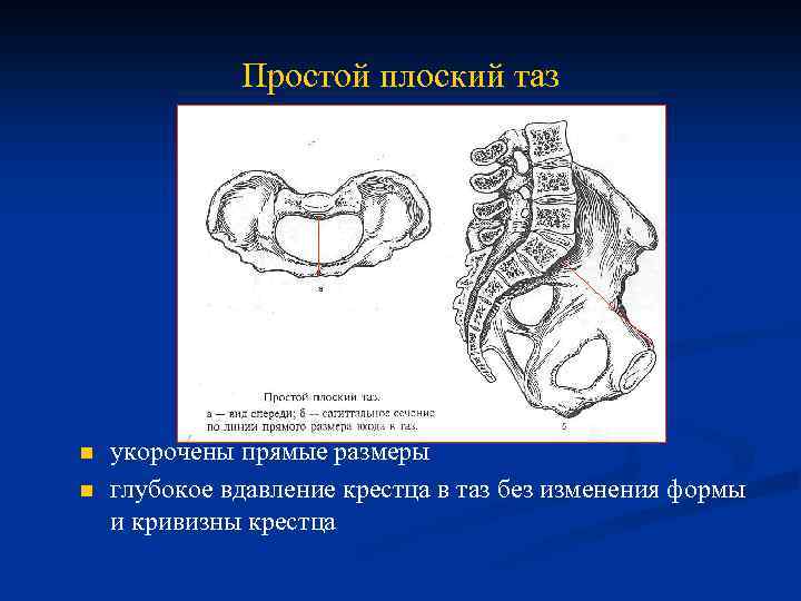 Узкий таз у женщин фото