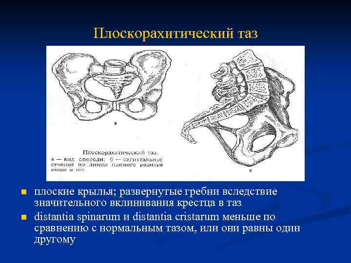 Плоскорахитический таз n n плоские крылья; развернутые гребни вследствие значительного вклинивания крестца в таз