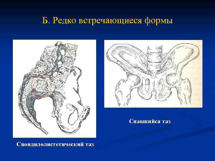 Б. Редко встречающиеся формы Спавшийся таз Спондилолистетический таз 