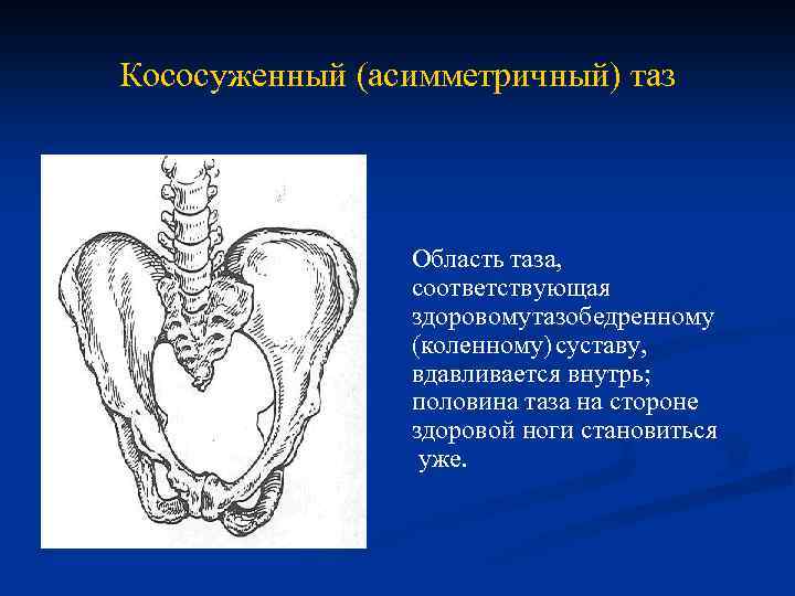 Кососуженный (асимметричный) таз Область таза, соответствующая здоровому тазобедренному (коленному) суставу, вдавливается внутрь; половина таза