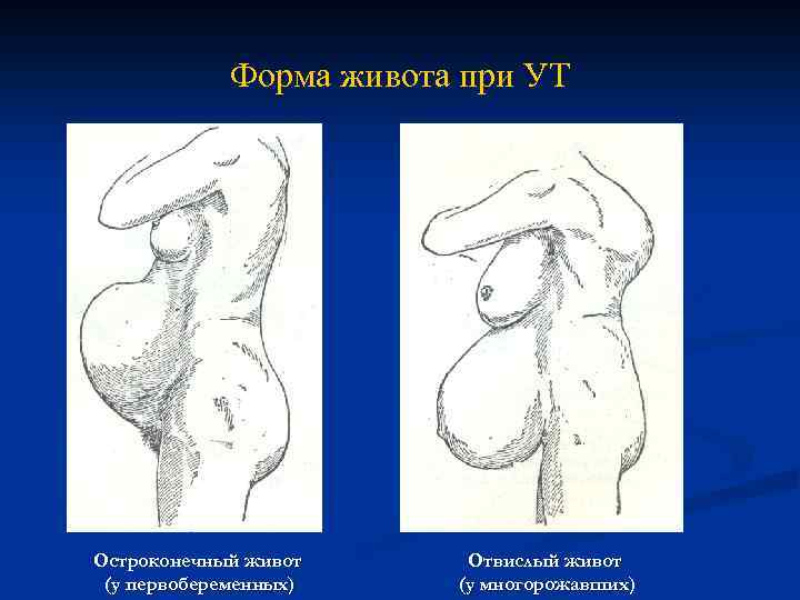 Форма живота при УТ Остроконечный живот (у первобеременных) Отвислый живот (у многорожавших) 