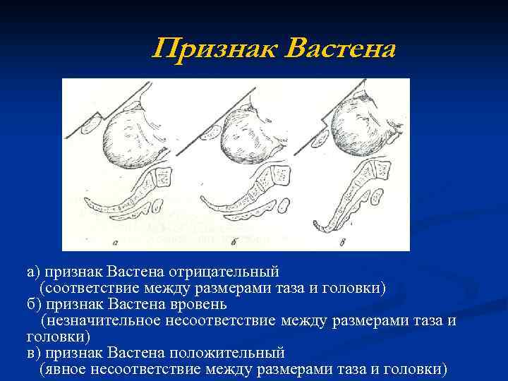 Признак Вастена а) признак Вастена отрицательный (соответствие между размерами таза и головки) б) признак