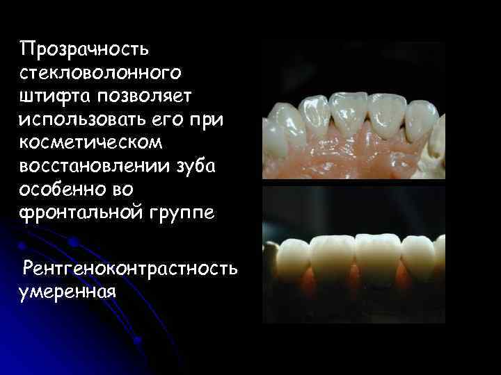 Штифтовые конструкции презентация