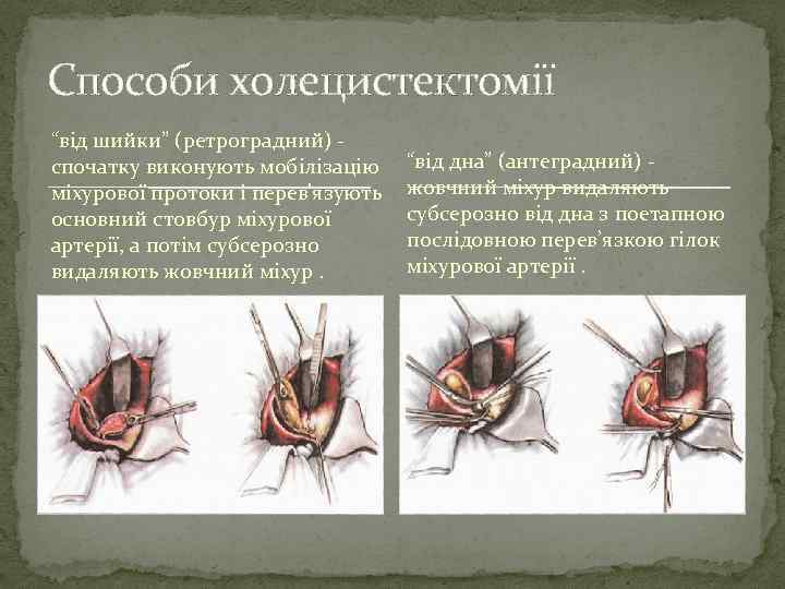 Способи холецистектомії “від шийки” (ретроградний) спочатку виконують мобілізацію міхурової протоки і перев'язують основний стовбур