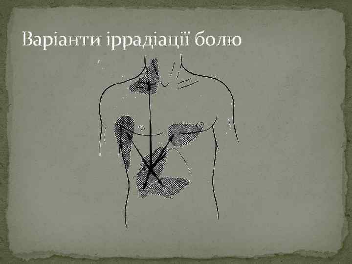 Варіанти іррадіації болю 