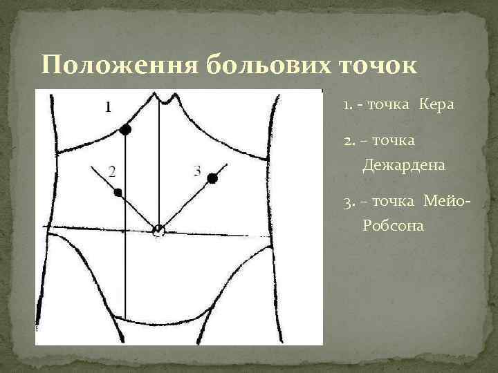 Положення больових точок 1. точка Кера 2. – точка Дежардена 3. – точка Мейо