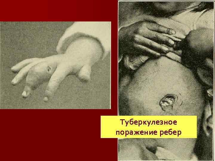 Туберкулезный пандактилит Туберкулезное поражение ребер 