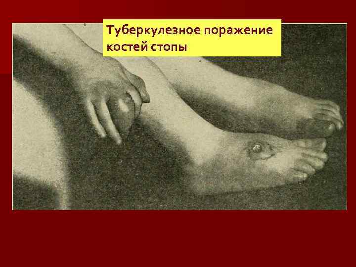 Туберкулезное поражение костей стопы 