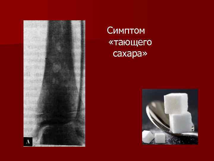 Симптом «тающего сахара» 