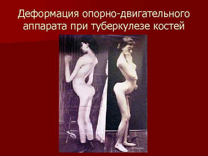 Деформация опорно-двигательного аппарата при туберкулезе костей 