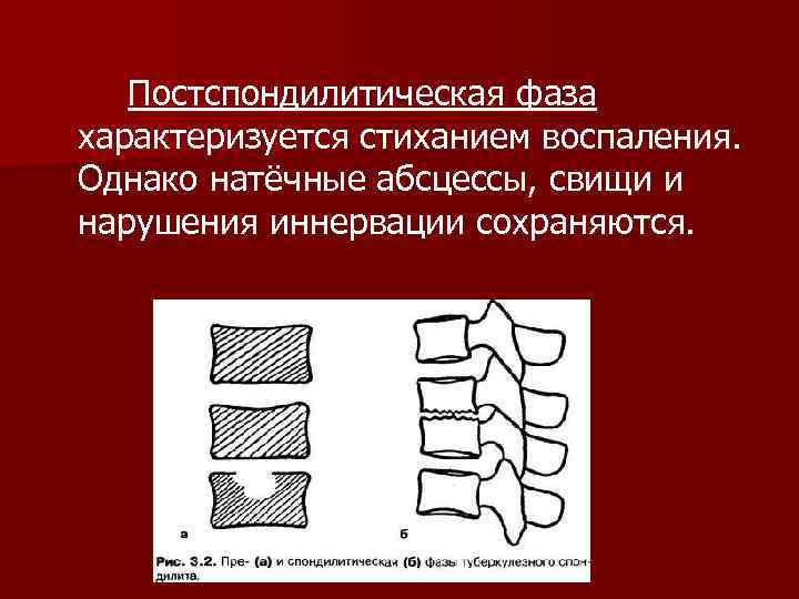  Постспондилитическая фаза характеризуется стиханием воспаления. Однако натёчные абсцессы, свищи и нарушения иннервации сохраняются.