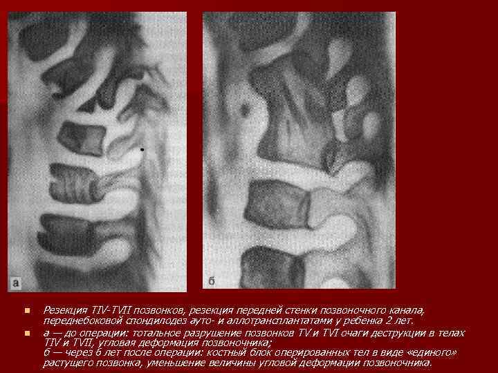 n n Резекция TIV-ТVII позвонков, резекция передней стенки позвоночного канала, переднебоковой спондилодез ауто- и