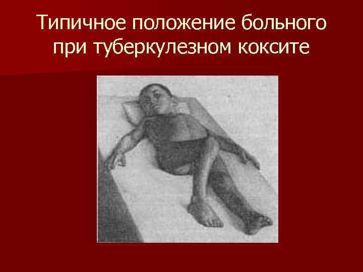 Типичное положение больного при туберкулезном коксите 