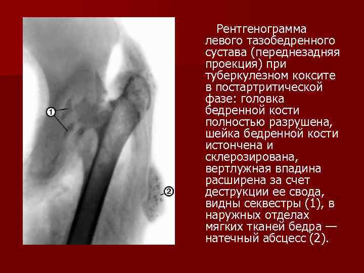 Туберкулез костей презентация