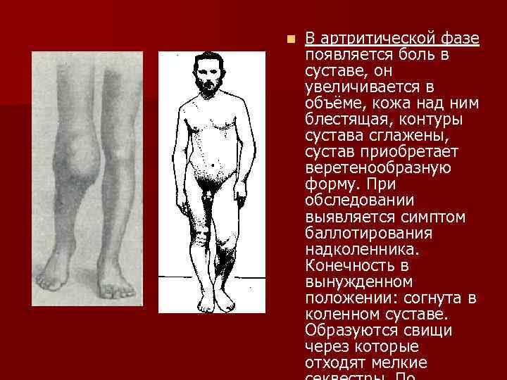 n В артритической фазе появляется боль в суставе, он увеличивается в объёме, кожа над