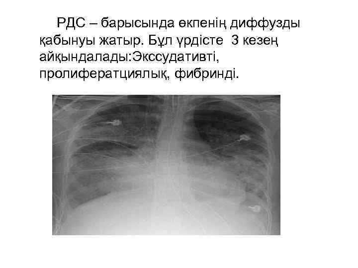 РДС – барысында өкпенің диффузды қабынуы жатыр. Бұл үрдісте 3 кезең айқындалады: Экссудативті, пролифератциялық,
